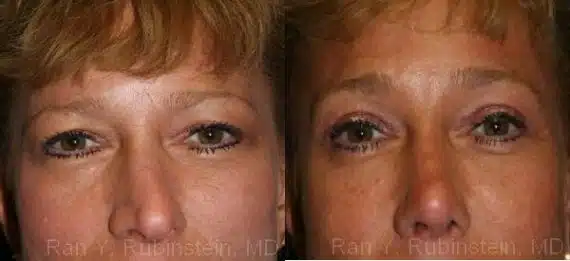 Brow Lift Before and After Photos in Newburgh, NY, Patient 12516