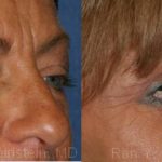 Brow Lift Before and After Photos in Newburgh, NY, Patient 12522