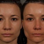 Ethnic Rhinoplasty Before and After Photos in Newburgh, NY, Patient 12528