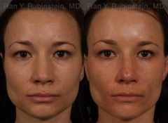 Ethnic Rhinoplasty Before and After Photos in Newburgh, NY, Patient 12528