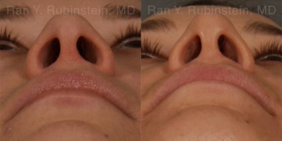 Ethnic Rhinoplasty Before and After Photos in Newburgh, NY, Patient 12528