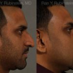 Ethnic Rhinoplasty Before and After Photos in Newburgh, NY, Patient 12538