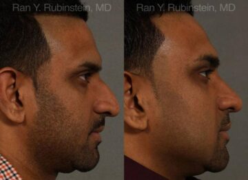 Ethnic Rhinoplasty Before and After Photos in Montvale, NJ, Patient 12538
