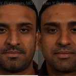 Ethnic Rhinoplasty Before and After Photos in Newburgh, NY, Patient 12538