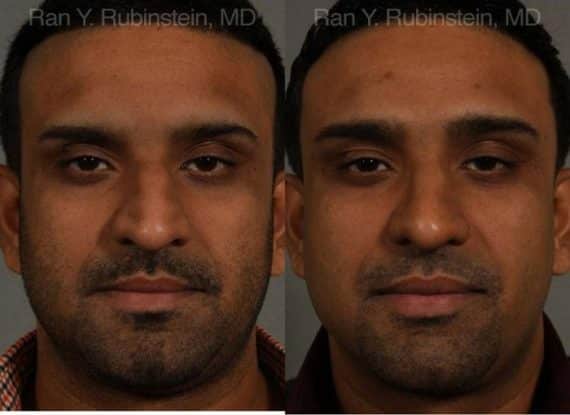 Ethnic Rhinoplasty Before and After Photos in Newburgh, NY, Patient 12538