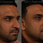 Ethnic Rhinoplasty Before and After Photos in Newburgh, NY, Patient 12538