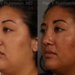 Ethnic Rhinoplasty Before and After Photos in Newburgh, NY, Patient 12545