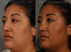 Ethnic Rhinoplasty Before and After Photos in Newburgh, NY, Patient 12545