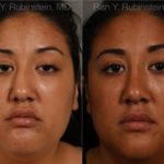 Ethnic Rhinoplasty Before and After Photos in Newburgh, NY, Patient 12545