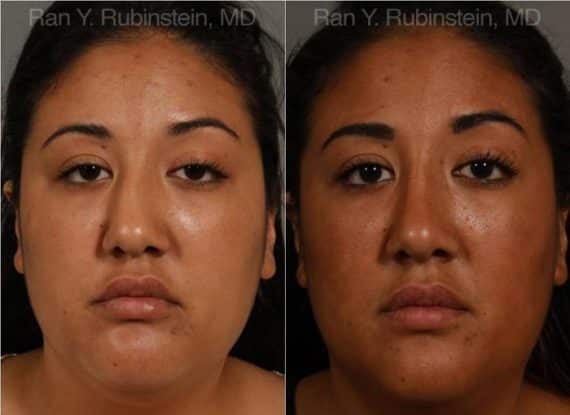 Ethnic Rhinoplasty Before and After Photos in Newburgh, NY, Patient 12545