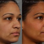 Ethnic Rhinoplasty Before and After Photos in Newburgh, NY, Patient 12550