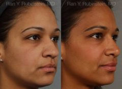 Ethnic Rhinoplasty Before and After Photos in Newburgh, NY, Patient 12550