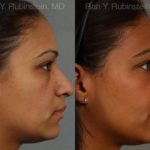 Ethnic Rhinoplasty Before and After Photos in Newburgh, NY, Patient 12550