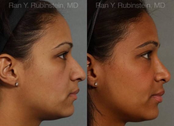 Ethnic Rhinoplasty Before and After Photos in Newburgh, NY, Patient 12550