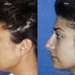 Ethnic Rhinoplasty Before and After Photos in Newburgh, NY, Patient 12555