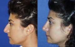 Ethnic Rhinoplasty Before and After Photos in Newburgh, NY, Patient 12555