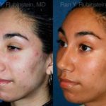 Ethnic Rhinoplasty Before and After Photos in Newburgh, NY, Patient 12568