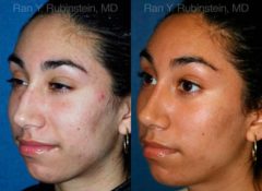 Ethnic Rhinoplasty Before and After Photos in Newburgh, NY, Patient 12568