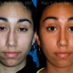 Ethnic Rhinoplasty Before and After Photos in Newburgh, NY, Patient 12568