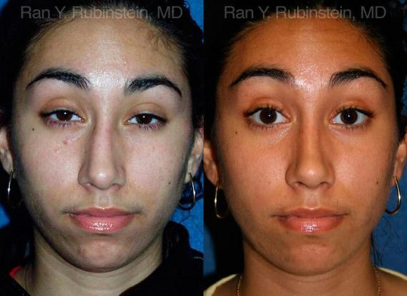 Ethnic Rhinoplasty Before and After Photos in Newburgh, NY, Patient 12568