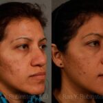 Ethnic Rhinoplasty Before and After Photos in Newburgh, NY, Patient 12573