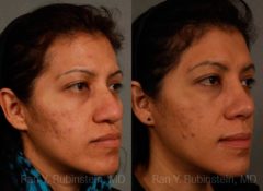 Ethnic Rhinoplasty Before and After Photos in Newburgh, NY, Patient 12573