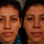 Ethnic Rhinoplasty Before and After Photos in Newburgh, NY, Patient 12573