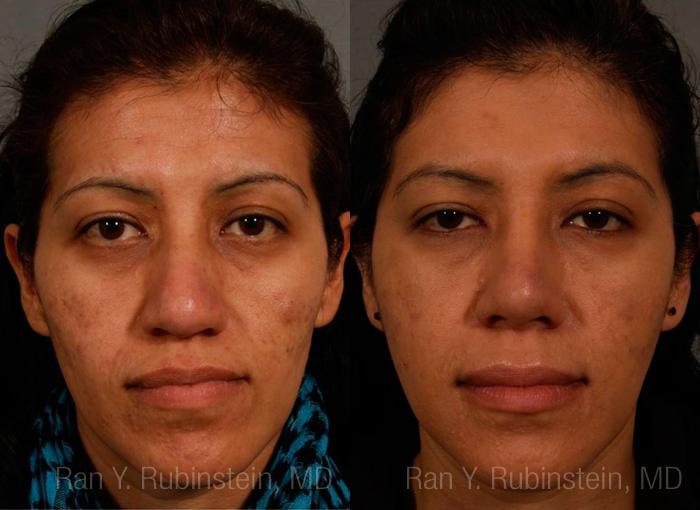 Ethnic Rhinoplasty Before and After Photos in Newburgh, NY, Patient 12573