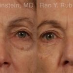 Eyelid Surgery Before and After Photos in Newburgh, NY, Patient 12583