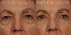 Eyelid Surgery Before and After Photos in Newburgh, NY, Patient 12583