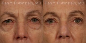 Eyelid Surgery Before and After Photos in Montvale, NJ, Patient 12583