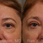 Eyelid Surgery Before and After Photos in Newburgh, NY, Patient 12596