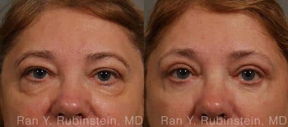 Eyelid Surgery Before and After Photos in Newburgh, NY, Patient 12596