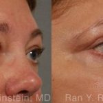 Eyelid Surgery Before and After Photos in Newburgh, NY, Patient 12596