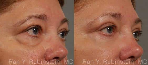 Eyelid Surgery Before and After Photos in Newburgh, NY, Patient 12596