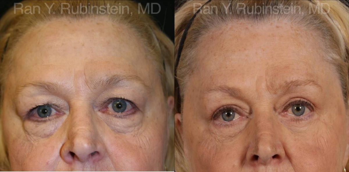 Eyelid Surgery Before and After Photos in Newburgh, NY, Patient 12601