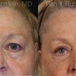 Eyelid Surgery Before and After Photos in Newburgh, NY, Patient 12601