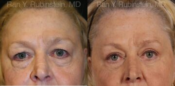 Eyelid Surgery Before and After Photos in Montvale, NJ, Patient 12601