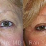 Eyelid Surgery Before and After Photos in Newburgh, NY, Patient 12604