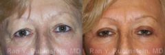 Eyelid Surgery Before and After Photos in Newburgh, NY, Patient 12604