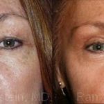 Eyelid Surgery Before and After Photos in Newburgh, NY, Patient 12607