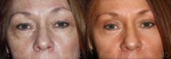 Eyelid Surgery Before and After Photos in Newburgh, NY, Patient 12607