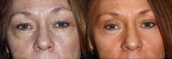 Eyelid Surgery Before and After Photos in Newburgh, NY, Patient 12607