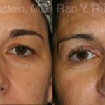 Eyelid Surgery Before and After Photos in Newburgh, NY, Patient 12613