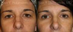 Eyelid Surgery Before and After Photos in Newburgh, NY, Patient 12613