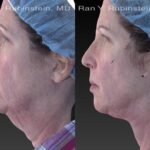 Face lift & Neck lift Before and After Photos in Newburgh, NY, Patient 12622