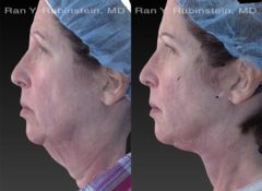 Face lift & Neck lift Before and After Photos in Newburgh, NY, Patient 12622