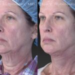 Face lift & Neck lift Before and After Photos in Newburgh, NY, Patient 12622