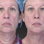 Face lift & Neck lift Before and After Photos in Newburgh, NY, Patient 12622