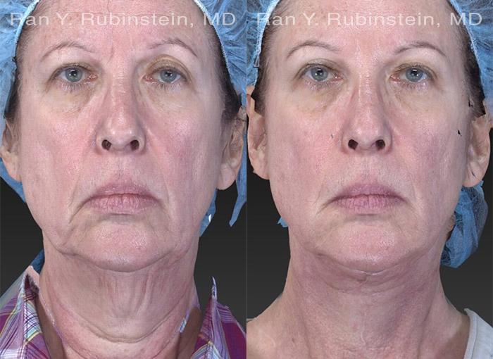 Face lift & Neck lift Before and After Photos in Newburgh, NY, Patient 12622